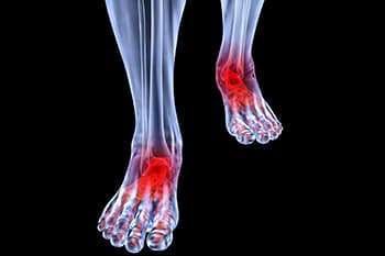 Arthritic foot and ankle care treatment in the Brookings, SD 57006 and Sioux Falls, SD 57106 area