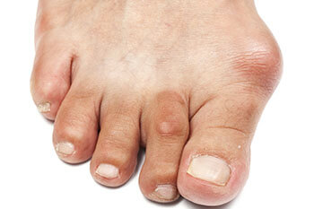Bunions treatment in the Brookings, SD 57006 and Sioux Falls, SD 57106 area