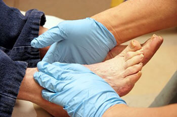 Diabetic foot care in the Sioux Falls, SD 57106 and Brookings, SD 57006 areas