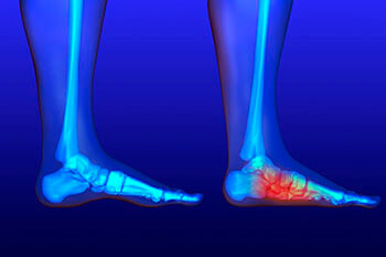 Flat Feet Treatment in the Brookings, SD 57006 and Sioux Falls, SD 57106 area
