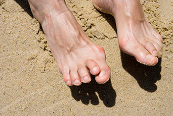Hammertoes specialist in the Brookings, SD 57006 and Sioux Falls, SD 57106 area