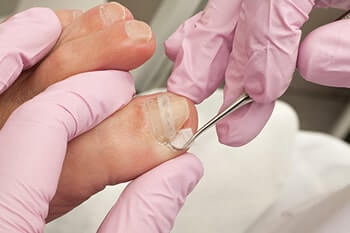 Ingrown Toenails Treatment in the Minnehaha County, SD: Sioux Falls (Harrisburg, Tea, Brandon, Renner, Ellis, Benclare, Buffalo Ridge, Rowena, Crooks, Corson) areas