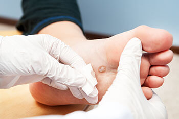 Plantar Warts Treatment in the Brookings, SD 57006 and Sioux Falls, SD 57106 area