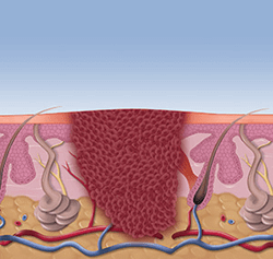 SWIFT Wart Treatment in the Minnehaha County, SD: Sioux Falls (Harrisburg, Tea, Brandon, Renner, Ellis, Benclare, Buffalo Ridge, Rowena, Crooks, Corson) areas