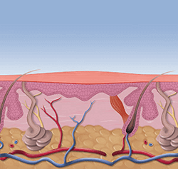 SWIFT Therapy for warts in the Minnehaha County, SD: Sioux Falls (Harrisburg, Tea, Brandon, Renner, Ellis, Benclare, Buffalo Ridge, Rowena, Crooks, Corson) areas