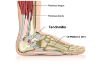 Many Reasons to Incur an Achilles Tendon Injury