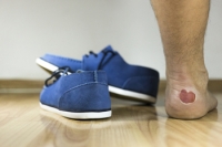 Why Do Blisters Form?
